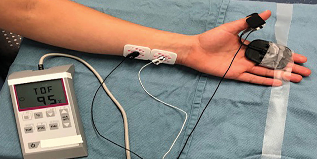 Figure 1: Depicts a quantitative neuromuscular blockade monitor being applied to the subject’s ulnar nerve.