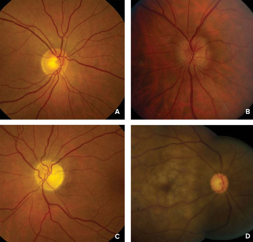 Figura 1: Fotografias do fundo do olho mostrando A) disco ótico normal ou neuropatia ótica isquêmica posterior em estágio inicial; B) ligeiro inchaço do disco na neuropatia ótica isquêmica anterior em estágio inicial; C) atrofia do nervo ótico na neuropatia ótica isquêmica anterior ou posterior em estágio avançado; e D) embranquecimento da retina, ponto vermelho-cereja (mácula) e artérias atenuadas na oclusão da artéria central da retina.<br />Fotografias gentilmente cedidas por Valerie Biousse, MD, e Nancy J. Newman, MD, Emory University School of Medicine, Atlanta, Geórgia.