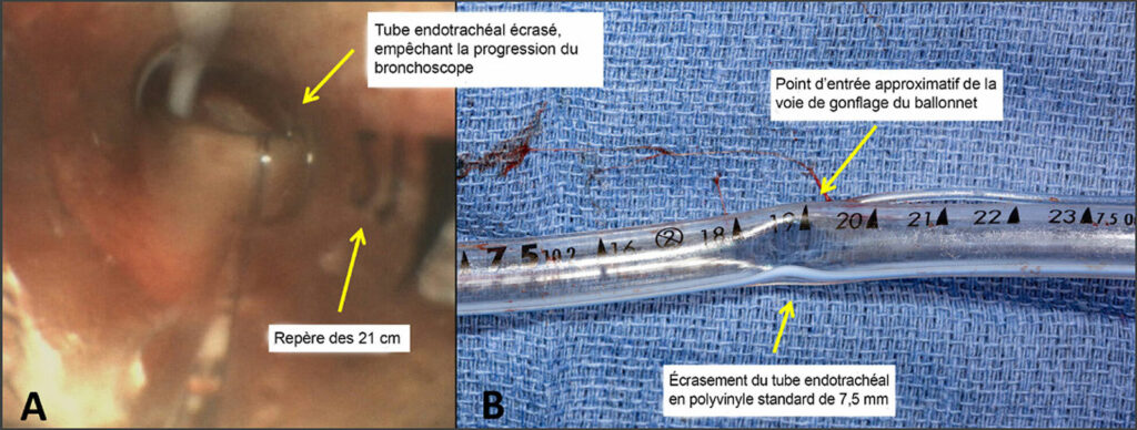 Figure A : Évaluation bronchoscopique représentant l’obstruction supraglottique du tube endotrachéal en polyvinyle près du repère à 19 centimètres.<br /> Figure B : Photographie de la sonde endotrachéale en polyvinyle de 7,5 centimètres du patient après l’extubation avec un rétrécissement luminal à angle aigu visible au repère des 19 centimètres.