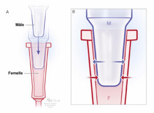 Figure 1 : A) Raccords coniques Luer mâle et femelle déconnectés. B) Raccords coniques Luer enclenchés pour former un raccordement étanche. Les flèches indiquent les forces de compression entre la paroi intérieure et la paroi extérieure du cône. L’étanchéité du raccord est assurée par l’association des forces de compression et du frottement entre les surfaces de contact. Remarque : les raccordements secs sont généralement moins susceptibles de se débrancher que si les surfaces des cônes sont humides.