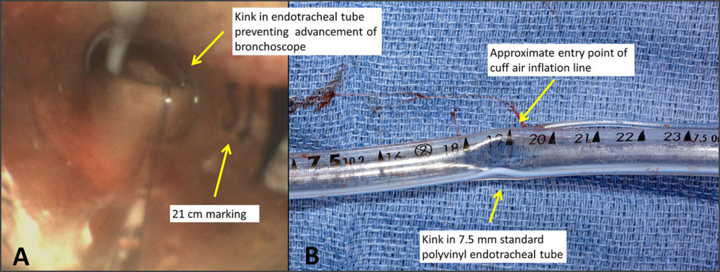 Figure A: Bronchoscopic evaluation demonstrating supraglottic obstruction of the polyvinyl endotracheal tube near the 19-centimeter marking. Figure B: Photograph of the patient’s 7.5 centimeter polyvinyl endotracheal tube following extubation with an acute angle luminal narrowing evident at the 19-centimeter marking.