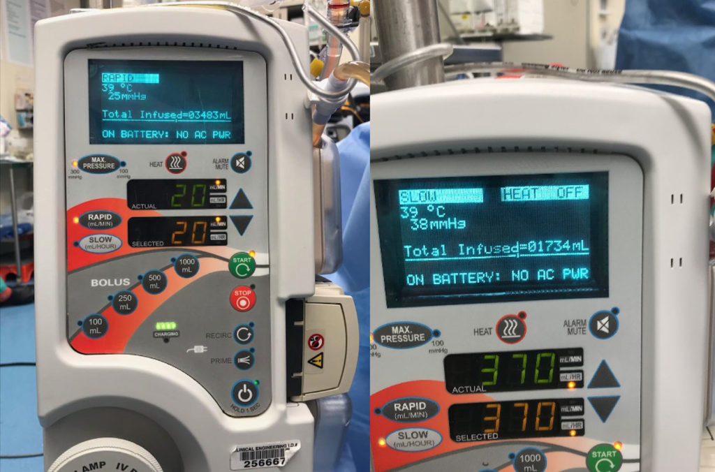 Figure 2: After the rapid infuser is unplugged, the display screen no longer states “HEAT ON” and instead clarifies “ON BATTERY: NO AC PWR,” and flashes “HEAT OFF.” (Note: Photos obtained after the actual clinical event.)