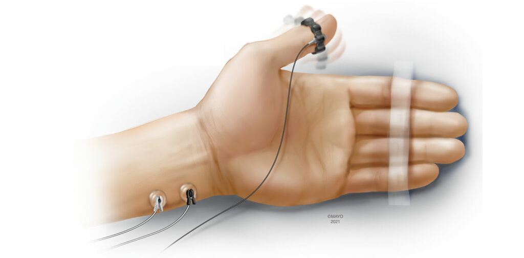 Figure 1: Acceleromyography