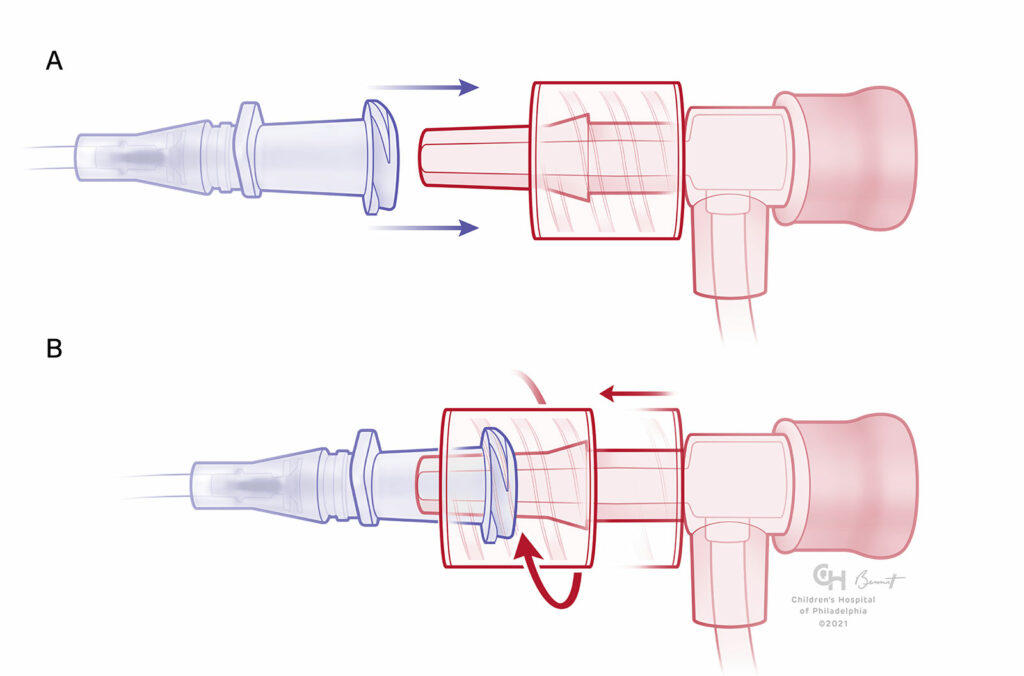 Figures 3:  A) Male Luer-Lock with swivel-skirt and receiving female component unengaged.   B) Swivel-skirt male component engaged.  Note that the swivel skirt allows the Luer taper to be engaged first and then secured with the skirt to avoid any twisting force on the attached tubing.